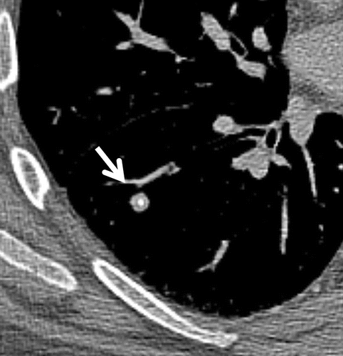 granuloma pulmonar com aspecto de nodulo com calcificacao central