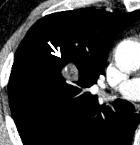 hamartoma pulmonar na tomografia computadorizada