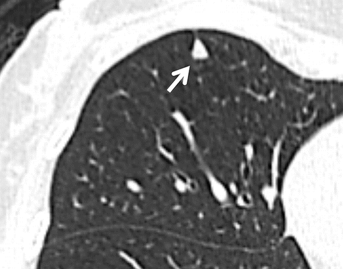 linfonodo subpleural intramural com morfologia triangular na tomografia computadorizada