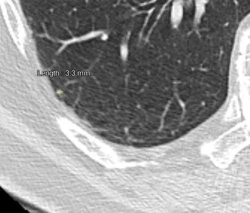 medida correta no plano axial de um micronodulo pulmonar benigno