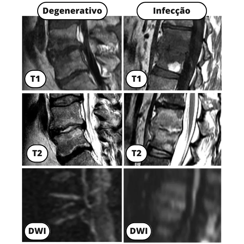 Sinal da garra na ressonância magnética diferencia infecção de doença degenerativa